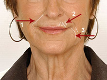 Treatment of wrinkles with Restylene before