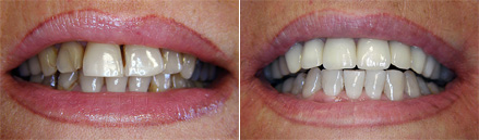 Glass porcelain crowns (before & after)