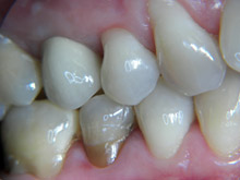 Loss of upper second premolar-after