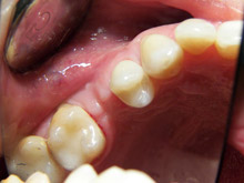 Loss of upper second premolar-before