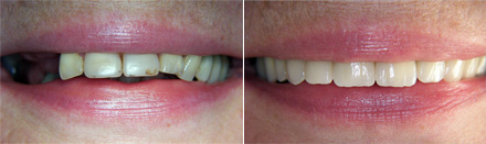 Reconstruction of upper lateral teeth with implants and crowns before & after