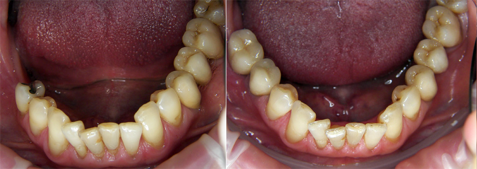 Restoration of the lost lower right molars with implants and crowns.