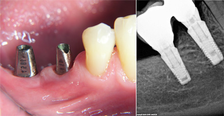 Titanium abutments. Radiograph images of implants,abutments and crowns.