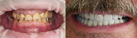 Full mouth rehabilitation with metal porcelain crowns and bridges: before and after