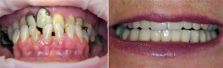 Zirconia porcelain crowns in the upper and lower jaw - before and after 