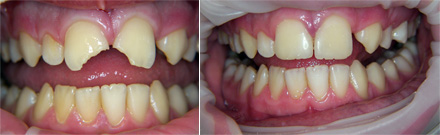 Reconstruction of fractured central incisors: before & after