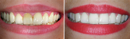 Redesign of smile: whitening of teeth and glass porcelain crown on second upper incisor - before and after