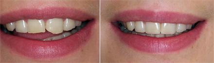 Composite fillings on  upper central incisors:before & after