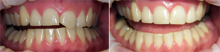 Asymmetry of the gingival contour - before and after