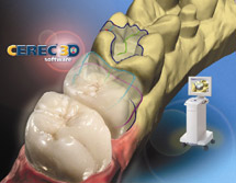 CEREC