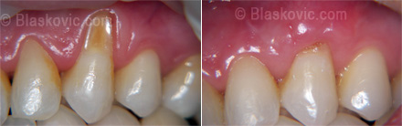 Povučeno zubno meso na gornjem lijevom očnjaku prije i poslije