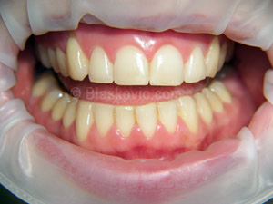 Produživanje kliničkih kruna zuba prije i poslije