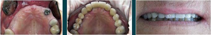 A)Mancanza di 9 denti B)Ponte su 4 impianti C)Sorriso nuovo