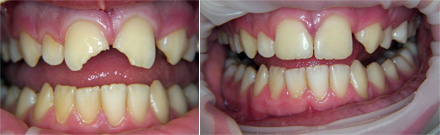 Gli incisivi superiori centrali fratturati: prima e dopo la ricostruzione. 